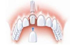 种植牙哪种材料好