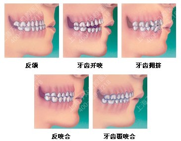 需要矫正的牙齿状态
