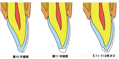 瓷贴面的价格是多少