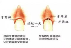 牙菌斑