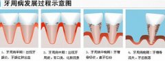 老人牙齿松动怎么办？