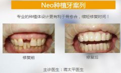 牙齿种植哪家医院比较上档次