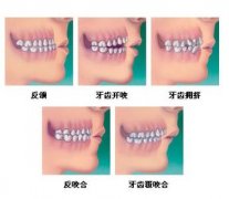 矫正牙齿大概费用多少